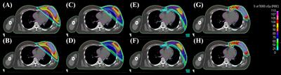 Dosimetric Comparison of Radiation Techniques for Comprehensive Regional Nodal Radiation Therapy for <mark class="highlighted">Left-Sided Breast</mark> Cancer: A Treatment Planning Study